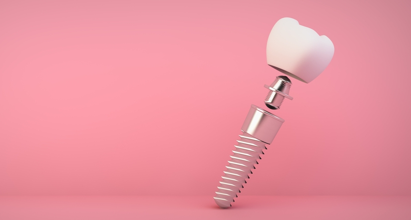 Dental implant specialist in Oxnard CA