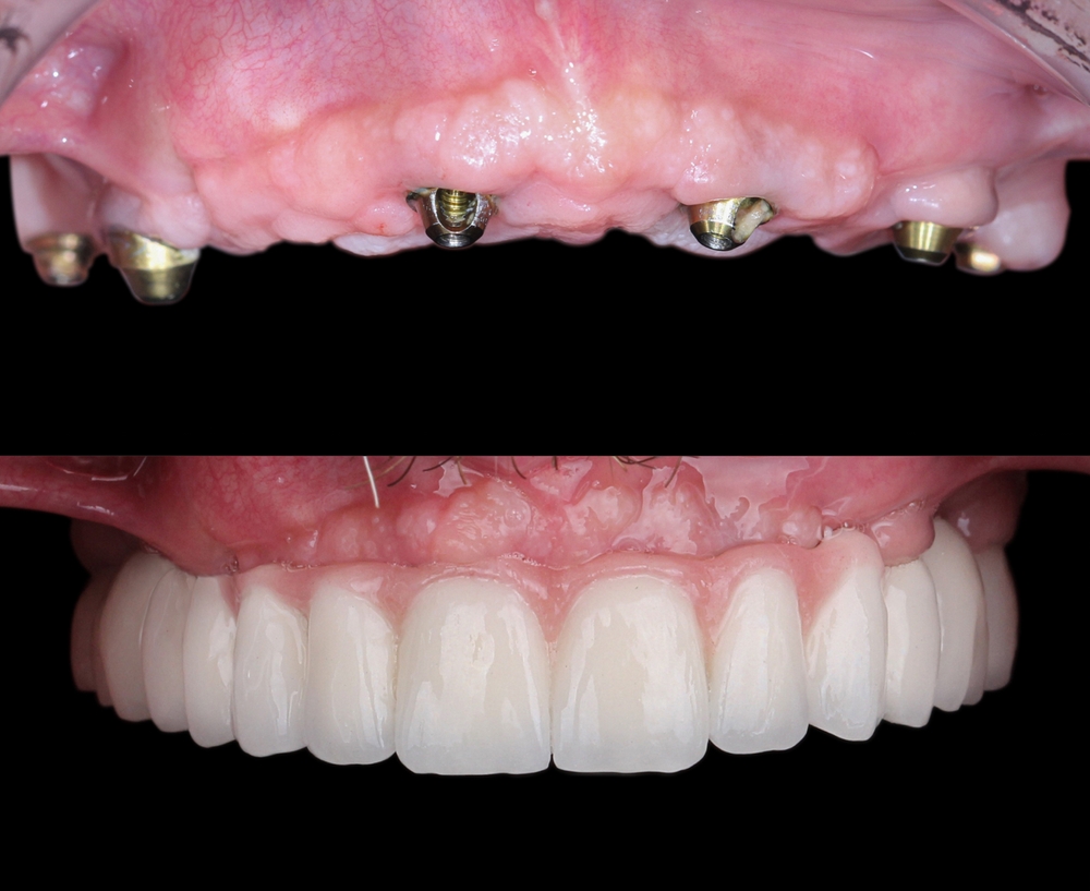 All-on-4 dental implants before and after results at Oxnard Gentle Dentistry
